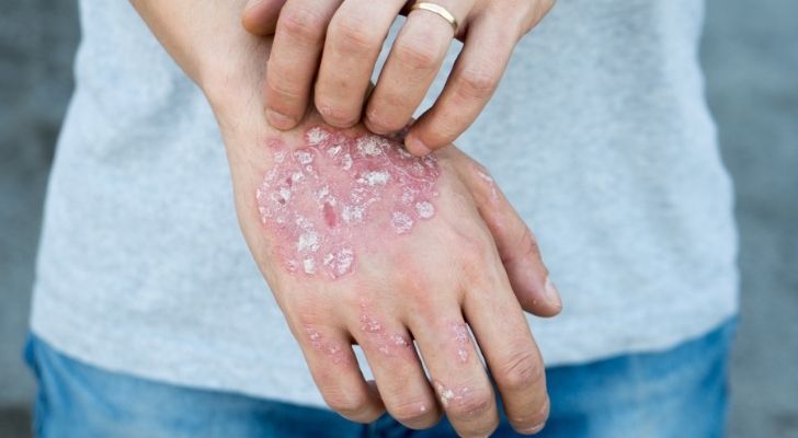 A rash on someones hand due to having an autoimmune disease